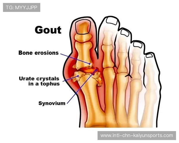 突尼斯希望中卫多次关键解围，尿酸700关节不疼还需要吃药吗